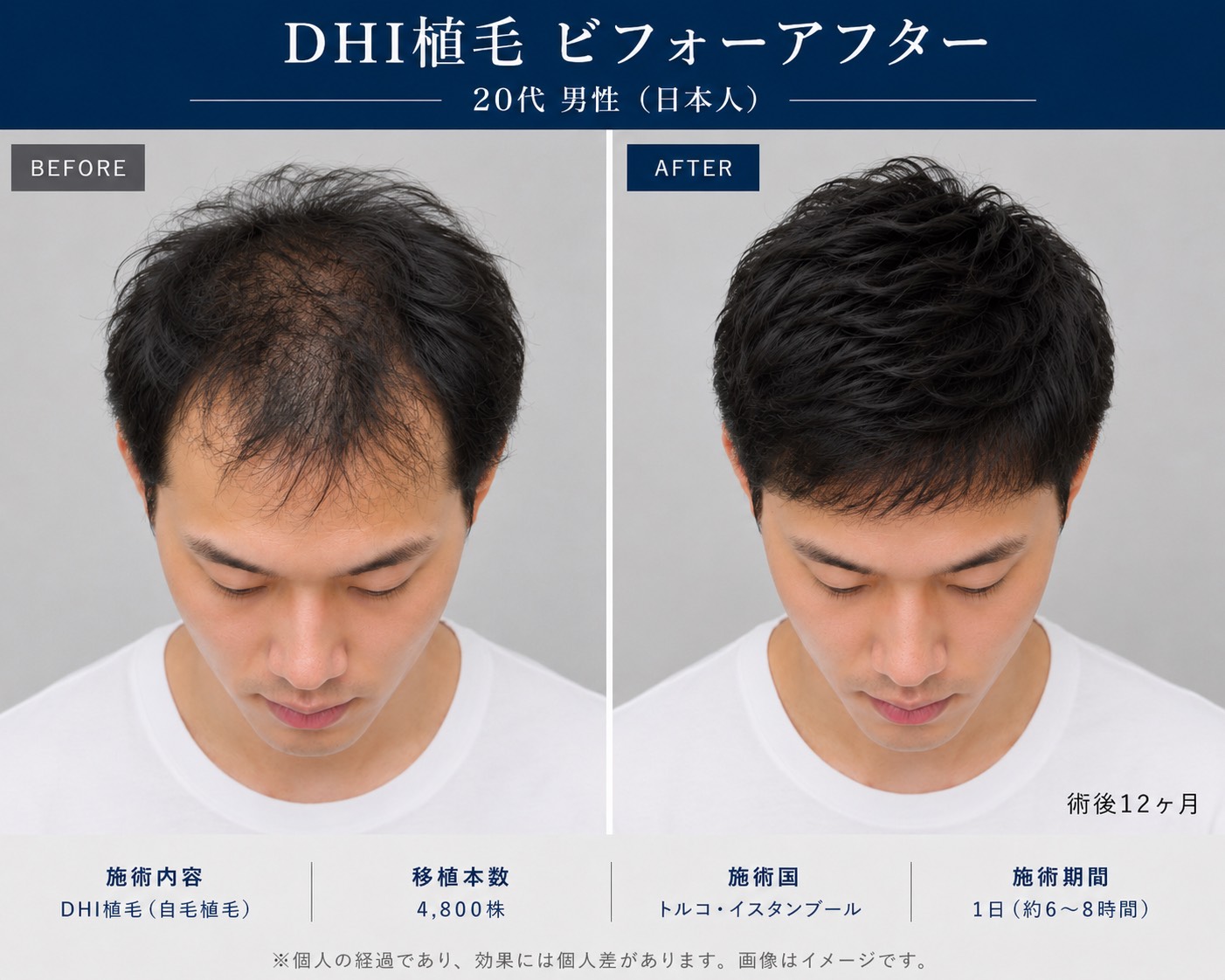 トルコ植毛のビフォーアフター事例（1）