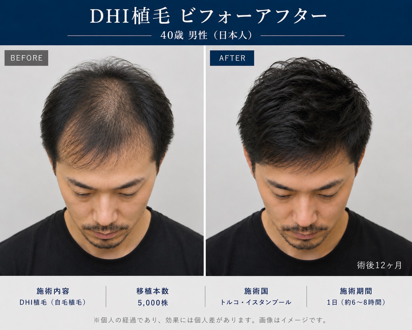 トルコ植毛のビフォーアフター事例（2）