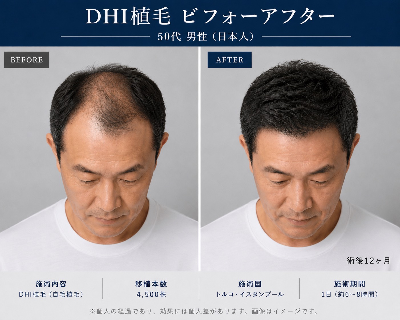 トルコ植毛のビフォーアフター事例（3）