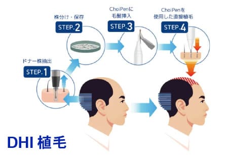 DHI植毛