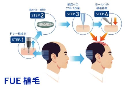 FUE植毛